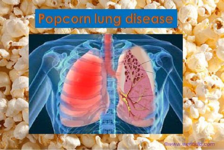 What causes popcorn lung?