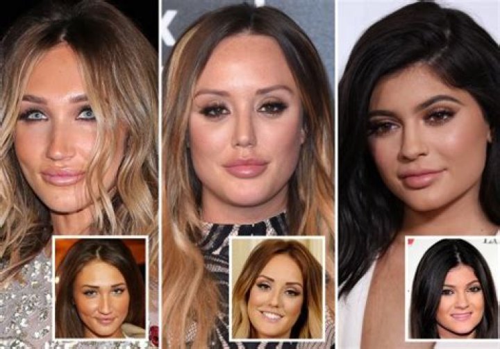 What celebrities get lip fillers?