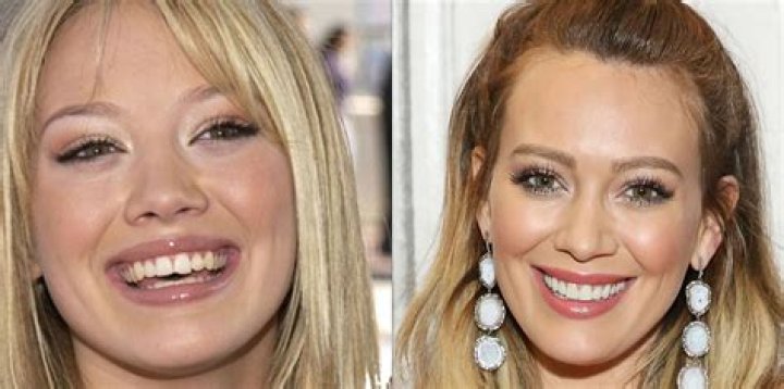 What celebrities have had their teeth fixed?