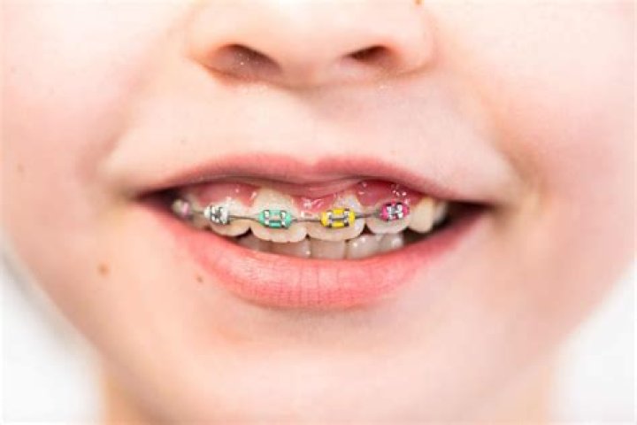 What color braces make teeth whiter?