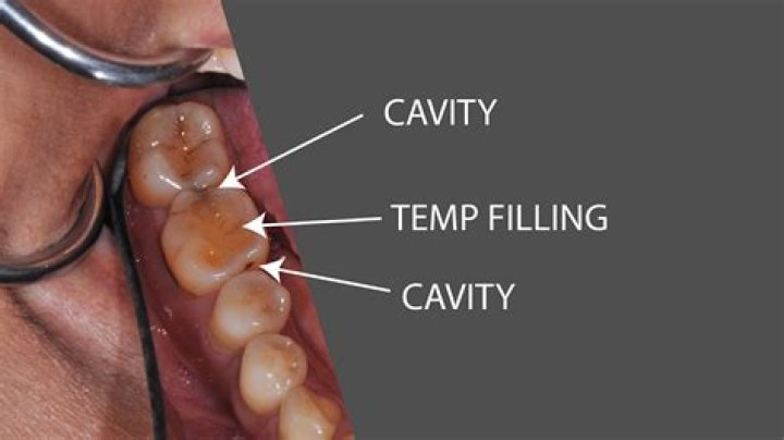 What color is cavity filling?