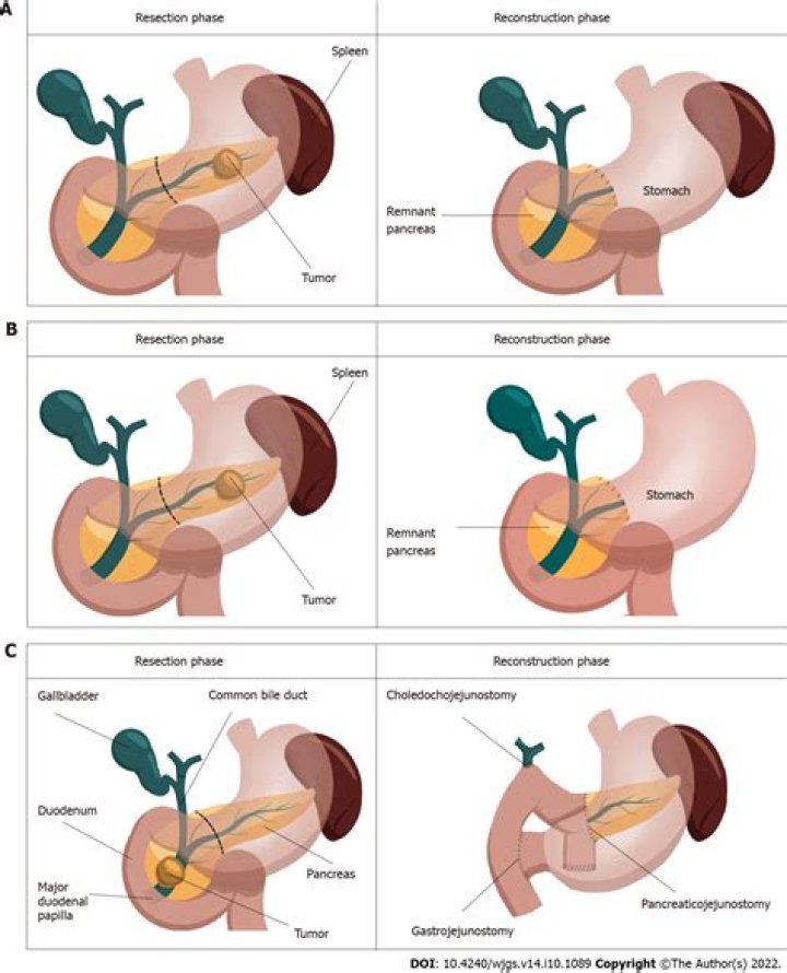 What color is fistula drainage?