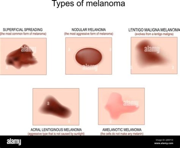What did your nodular melanoma look like?