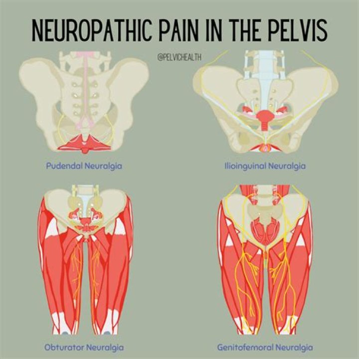 What diseases cause nerve pain?