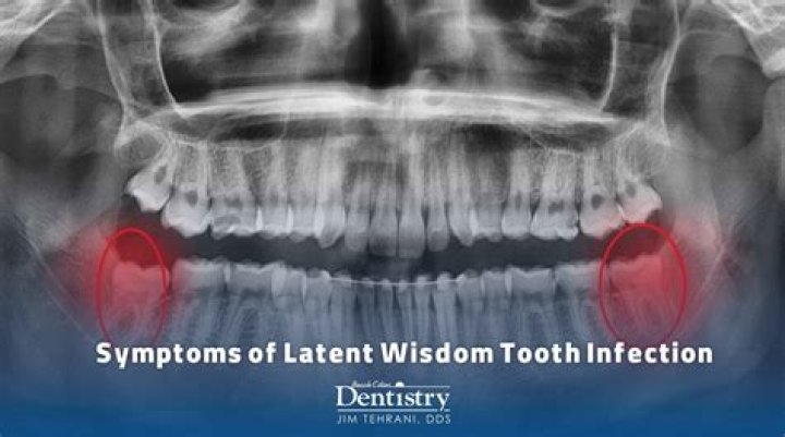 What do dentist do for infected wisdom tooth?