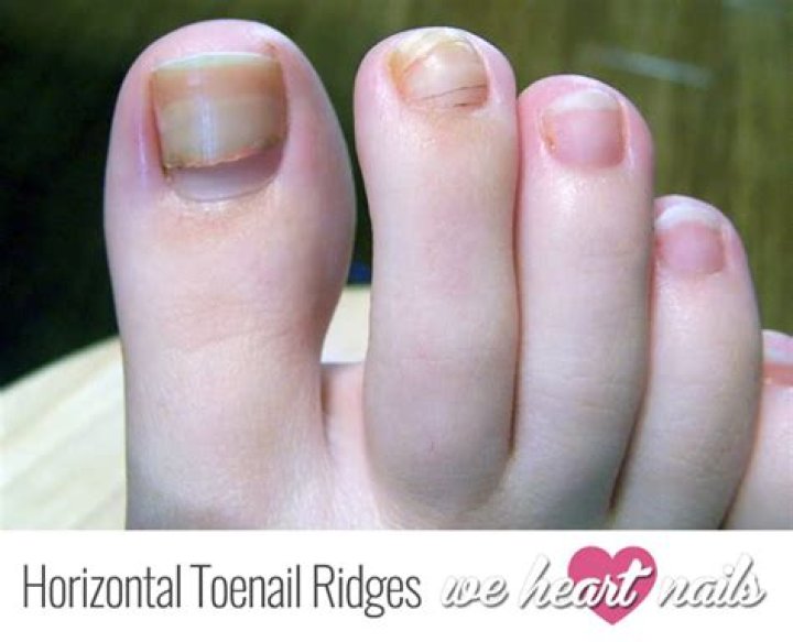 What do ridges on toenails mean?