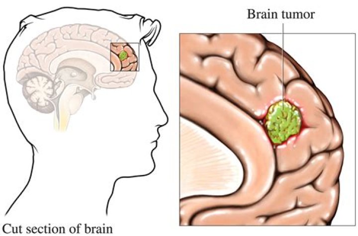 What does a brain tumor feel like in your head?