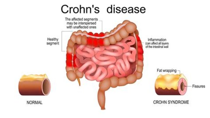 What does a Crohn's blockage feel like?