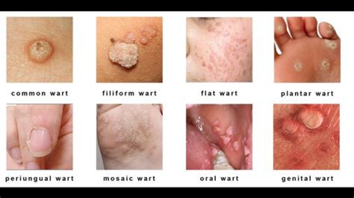 What does a crusty wart look like?