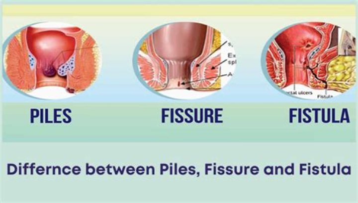 What does a fissure look like?