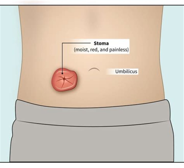 What does a herniated stoma look like?