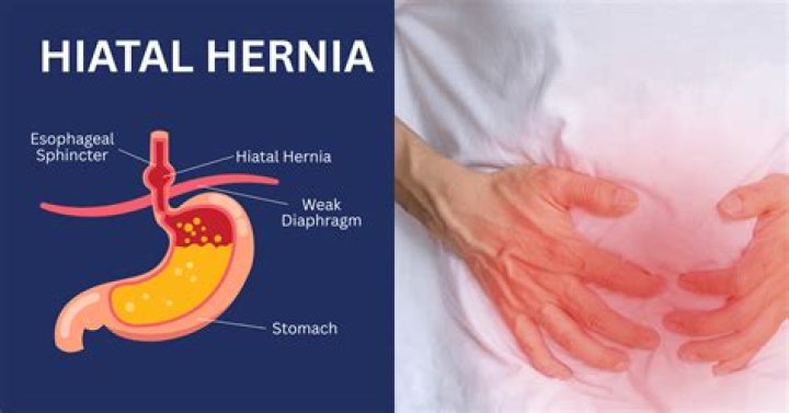 What does a hiatal hernia feel like in a woman?