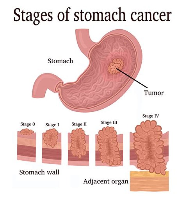 What does a stomach cancer lump feel like?