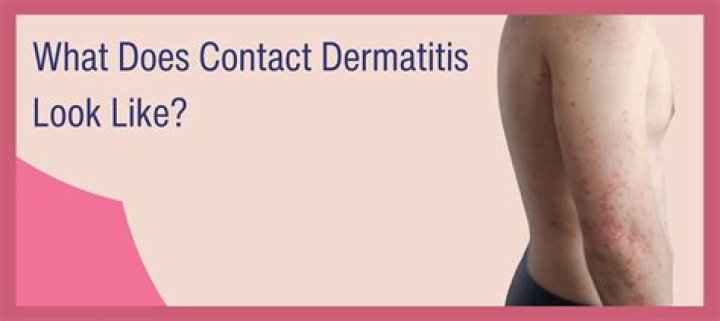 What does contact dermatitis look like?