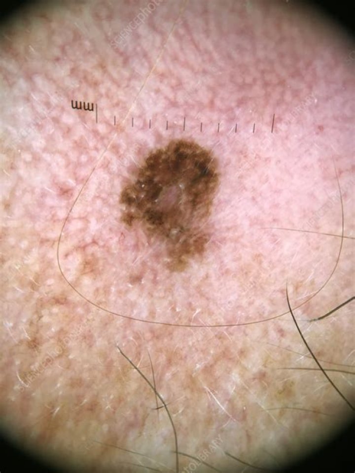 What does melanoma in situ look like?