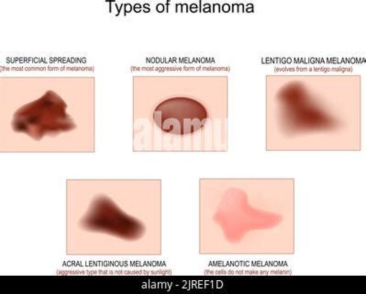 What does spreading melanoma look like?