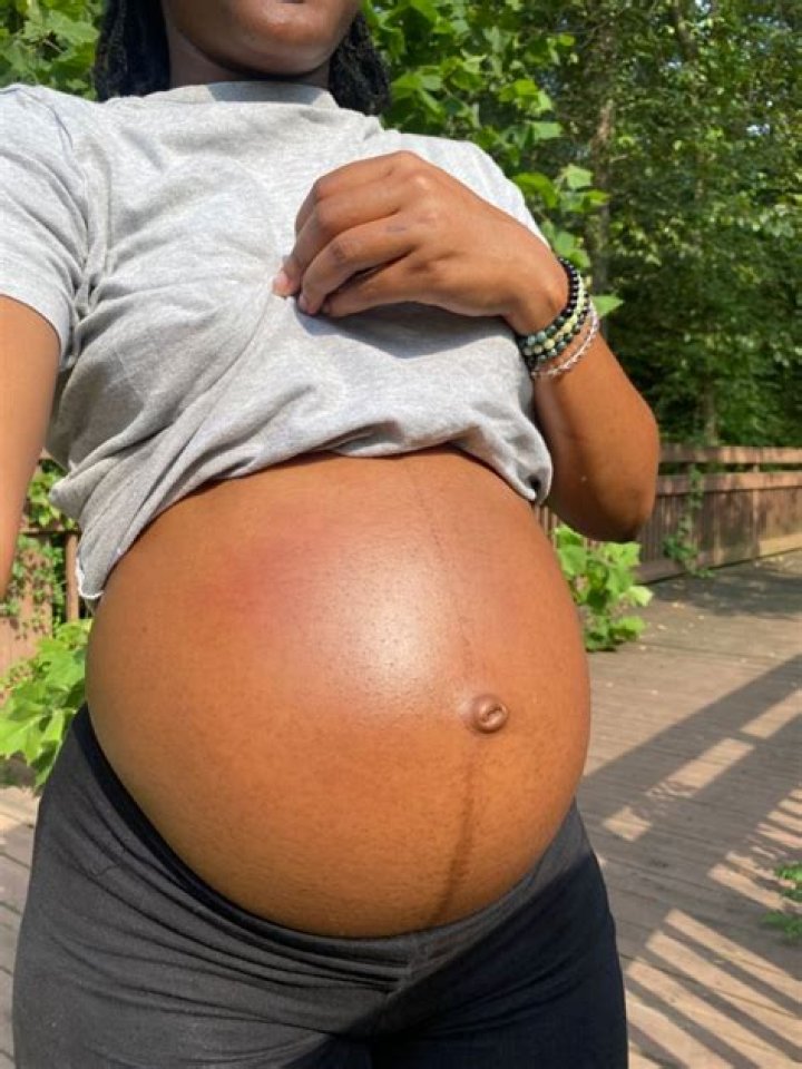 What does the black line on a pregnant belly mean?