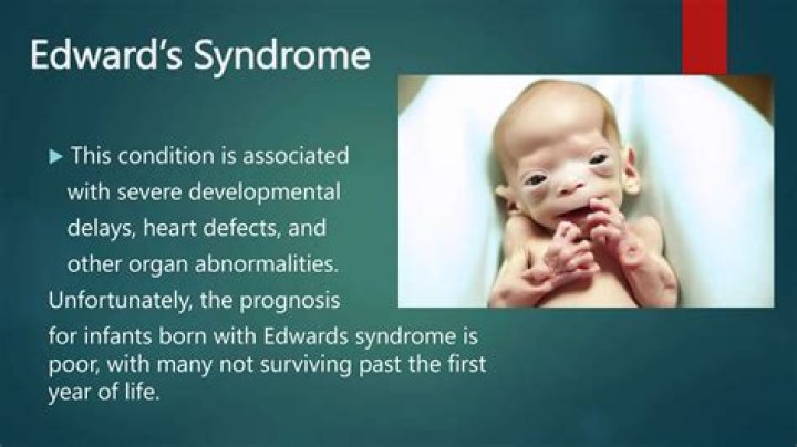 What gender does Edwards syndrome affect?