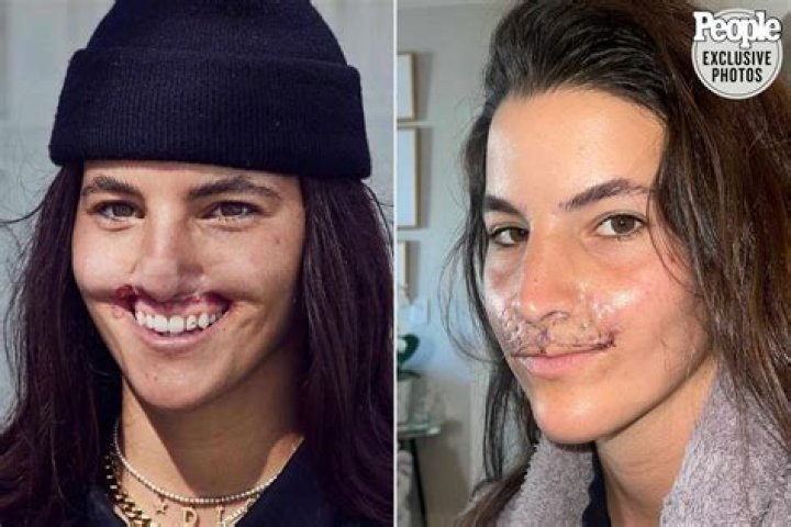 What happened to Brooklinn Khoury nose?