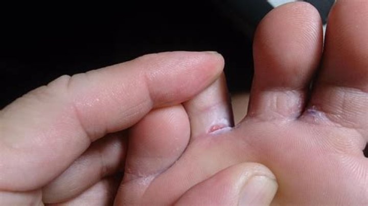What happens if athlete's foot goes untreated?