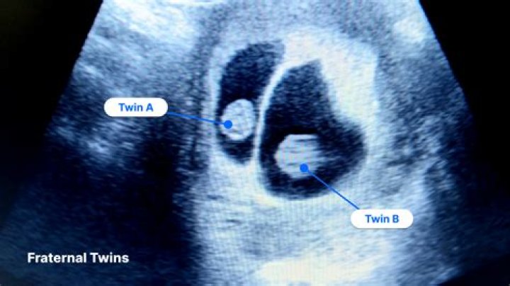 What happens if one identical twin dies in the womb?