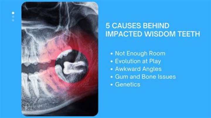 What happens if you have a hole in your wisdom teeth?