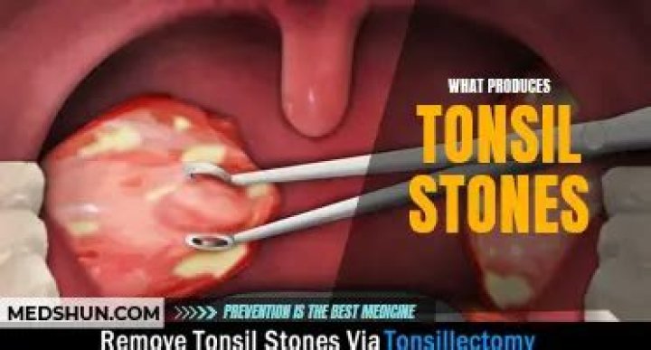 What happens if you swallow tonsil stones?
