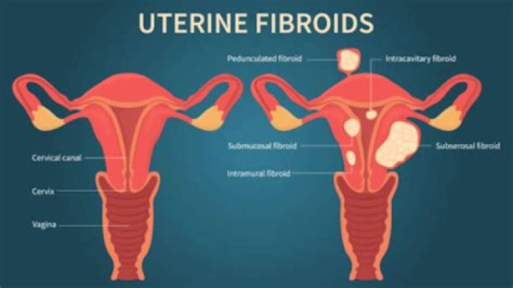 What happens when fibroids burst?