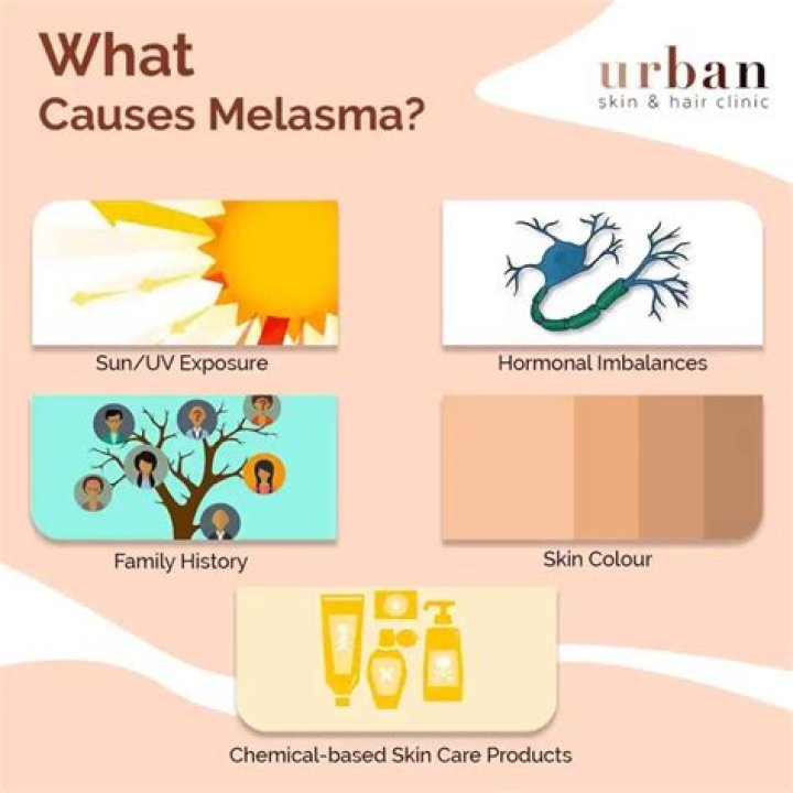 What hormone causes melasma?