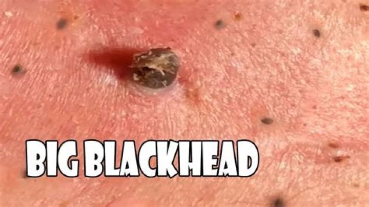 What is a blackhead seed?