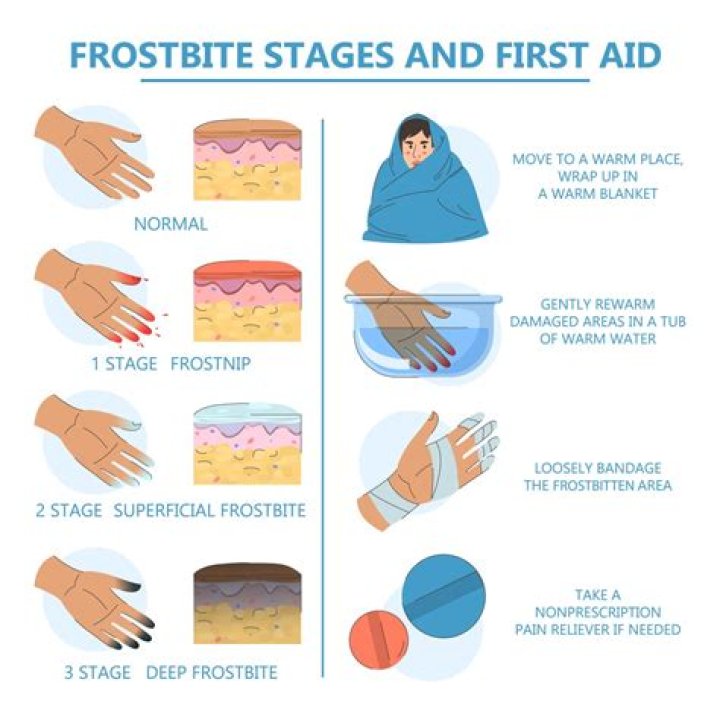 What is a frostbite worth in mm2?