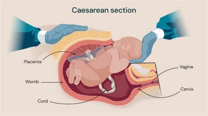 What is more painful C-section or normal birth?