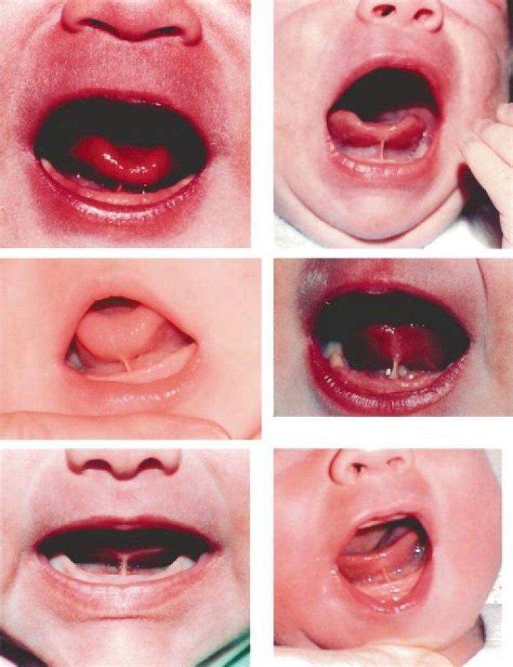 What is newborn tongue tie?