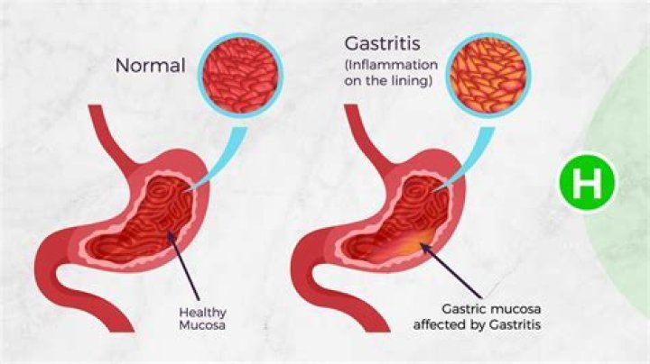 What is severe gastritis?