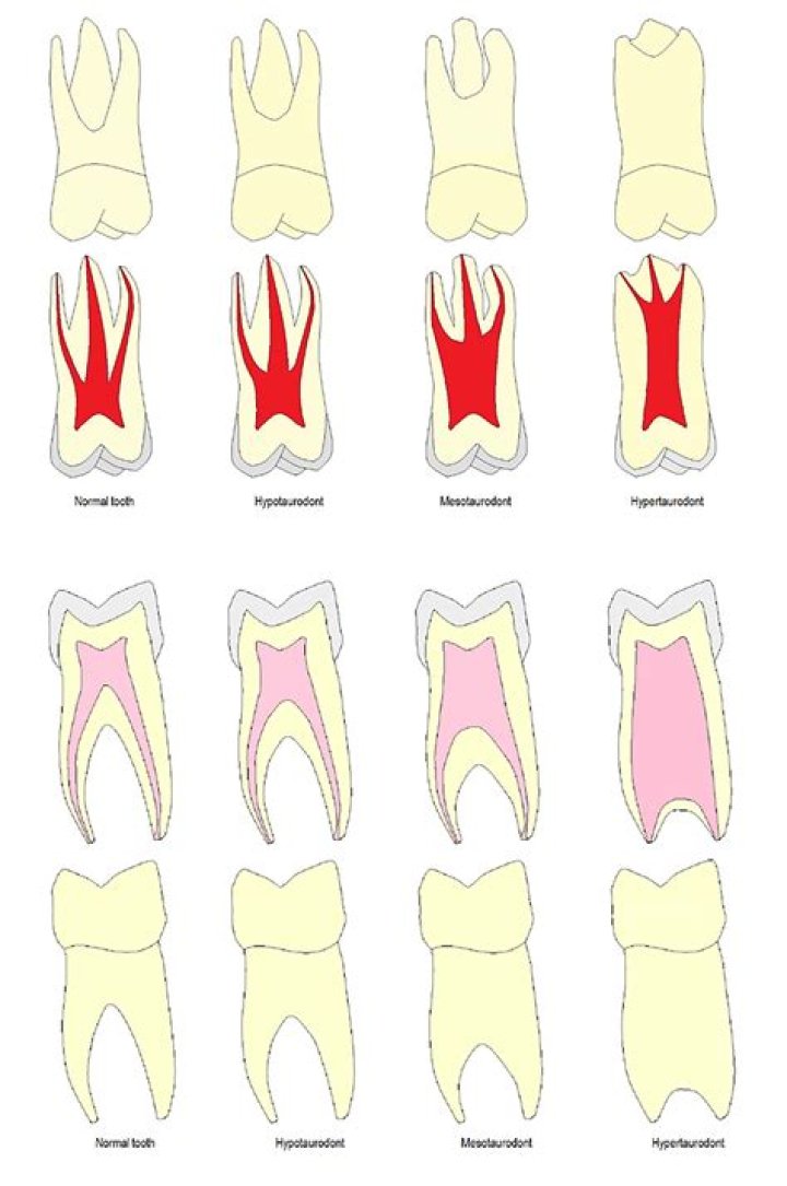 What is Taurodontism of teeth?