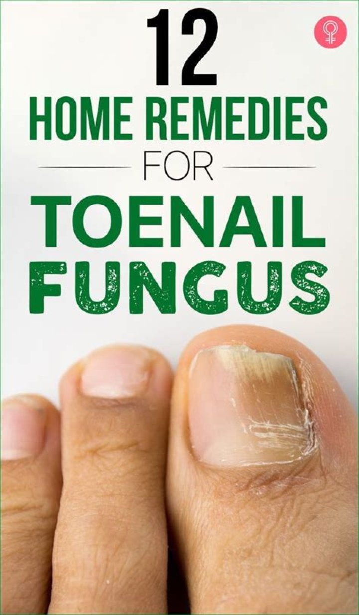 What is the best home remedy for toe fungus?