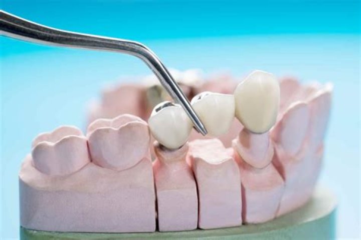 What is the cheapest type of dental bridge?