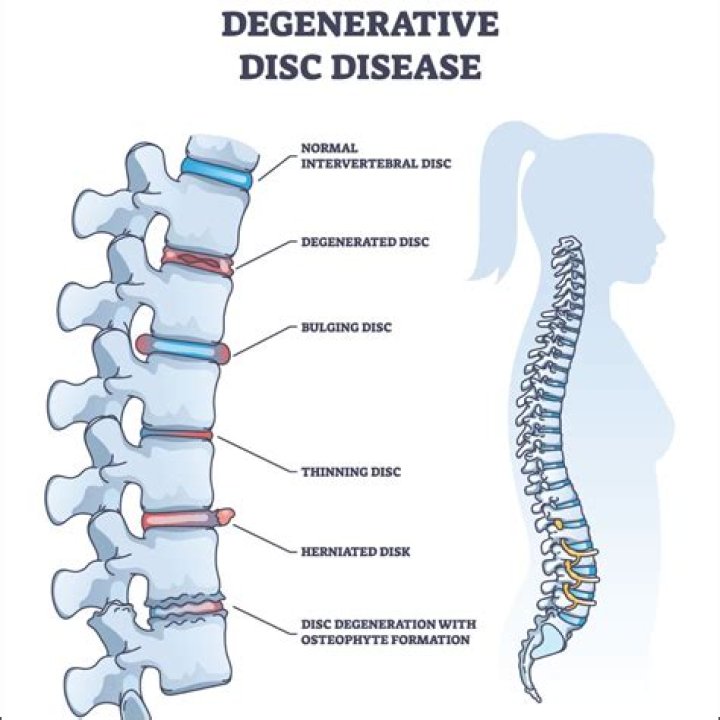 What is the difference between degenerative disc disease and spondylosis?