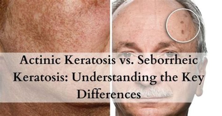 What is the fastest way to get rid of actinic keratosis?
