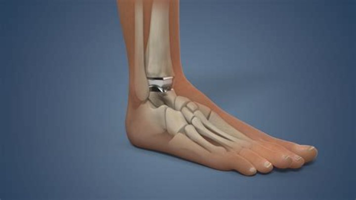 What is the purpose of a boot after ankle surgery?
