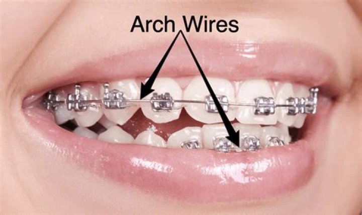 What is the thinner wire for braces?