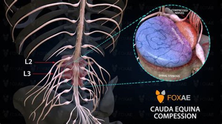 What nerves cause cauda equina?