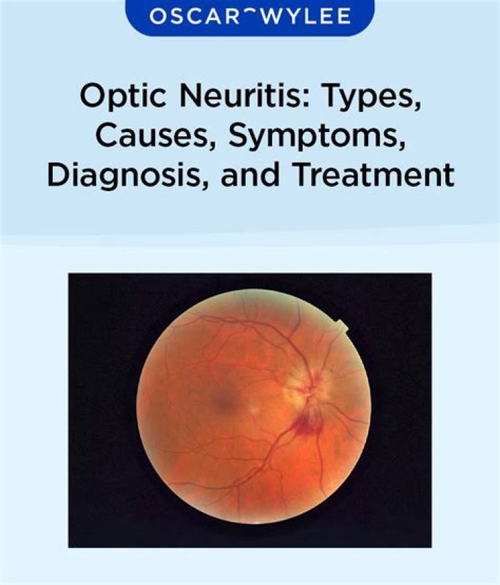 What optic neuritis looks like?