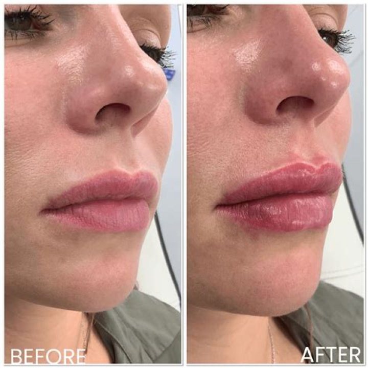 What should I not do after lip fillers?