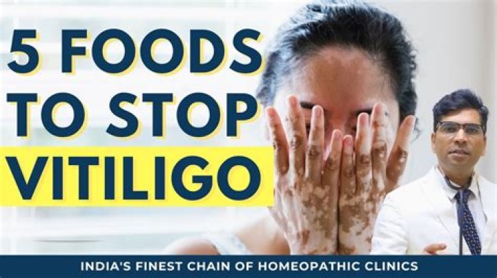 What should not eat in vitiligo?
