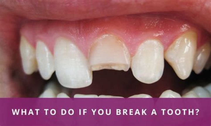 What should you not do with a broken tooth?