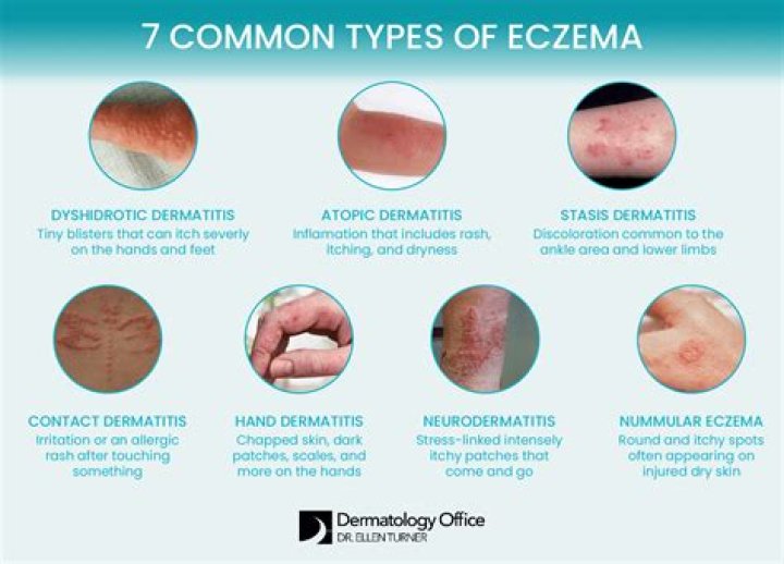 What vitamin is best for eczema?