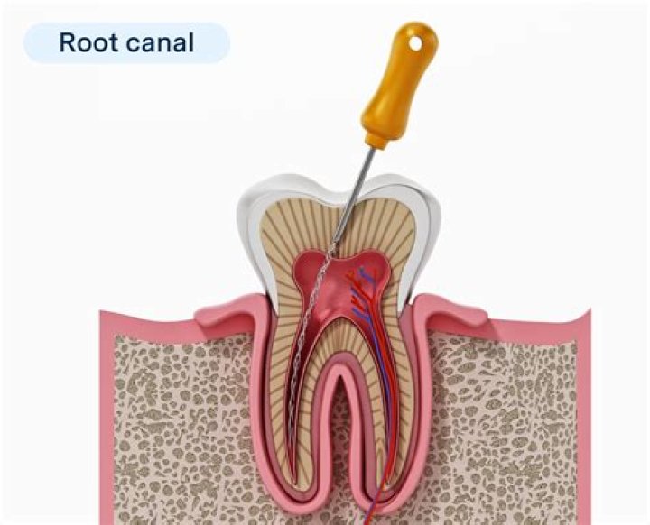 What's better root canal or implant?