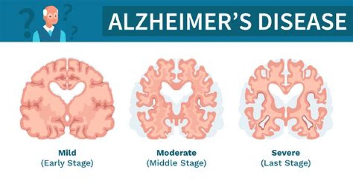 What's the earliest age Alzheimer's can start?