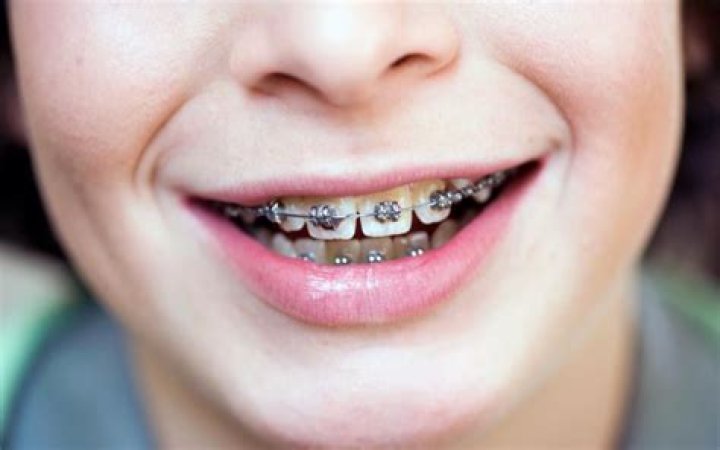 When do braces hurt the most?